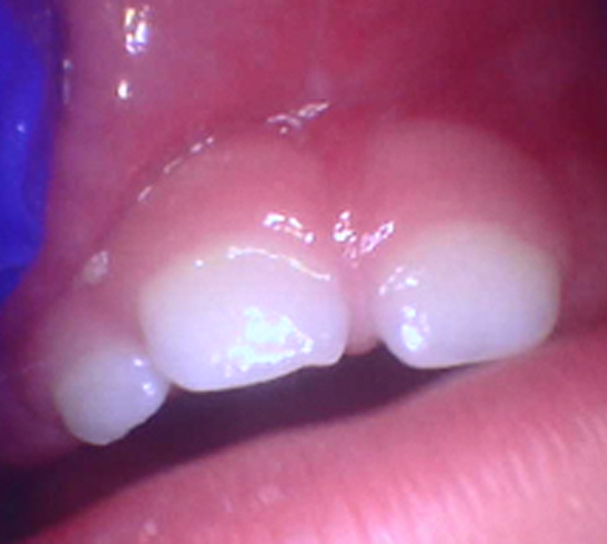 Tiny Trips Pediatric Dentistry | Space Maintainers, Pulp Therapy and Sleep Dentistry