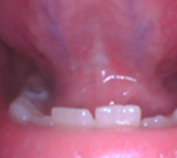 Tiny Trips Pediatric Dentistry | Dental Sealants, Pediatric Dental Emergencies and Fluoride Treatments