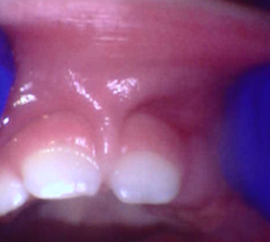 Tiny Trips Pediatric Dentistry | Lip   Tongue Tie Treatment, Extractions and Exams   Cleanings