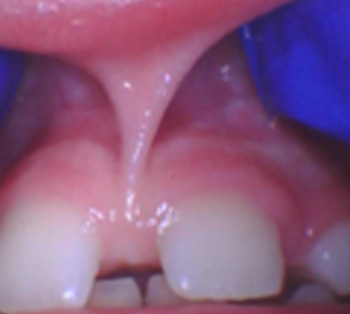 Tiny Trips Pediatric Dentistry | Extractions, Lip   Tongue Tie Treatment and Sleep Dentistry